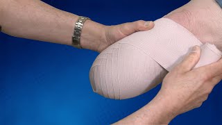 Wrapping Technique BK Residual Limb  Springer Prosthetic amp Orthotics Services [upl. by Curt803]