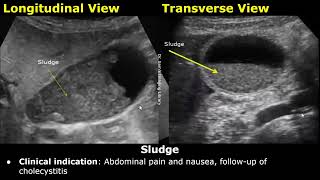 Gallbladder Ultrasound Reporting  GB Disease Scan Reports  How To Write USG Report  Abdominal USG [upl. by Eednak]