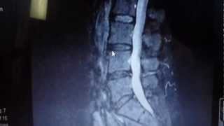 Escondido Chiropractor shows Disc Herniation Fixed with Spinal Decompression Therapy MRI Proves [upl. by Jasun]