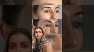 Polynucleotides for undereye rejuvenation  Dr MediSpa [upl. by Nibas438]