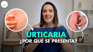 🔴 URTICARIA  Que es Sintomas y tratamiento drapilarochoa  Dermatologa [upl. by Htebasil]