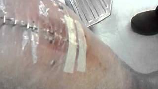 Dovies knee surgerystaples removed3g2 [upl. by Ocir212]