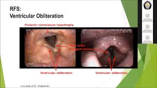 Laryngopharyngeal Reflux LPR [upl. by Etteiluj]