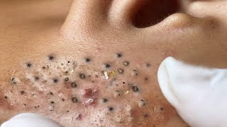 Big Cystic Acne Blackheads Extraction Blackheads amp Milia Whiteheads Removal Pimple Popping  3435 [upl. by Unity]