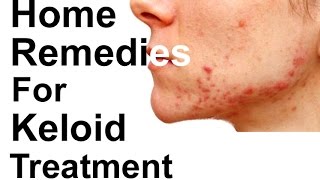 11 Home Remedies For Keloid Treatment  Keloid Removal  Keloid On Ear Face Nose [upl. by Norm35]