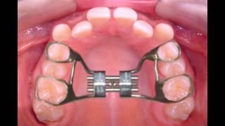 Rapid Palatal Expander [upl. by Boutis952]