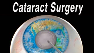 Cataract Eye Surgery Animation [upl. by Bryner]