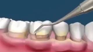 Teeth scaling and polishing [upl. by Attecnoc]