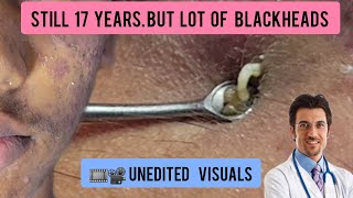 Blackheads extraction in a young male  blackheads blackheadremoval DrAMAZINGSKIN [upl. by Harrad]