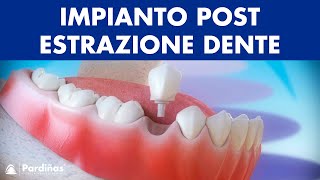 Trattamento parodontite – Curettage e sondaggio parodontale © [upl. by Greenquist]