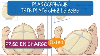 Problème de crâne plat chez le bébé des solutions [upl. by Macnamara818]