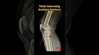 Tibial tuberosity Avulsion Fracture Xray Radiology avulsionfracture shorts xray [upl. by Marienthal]