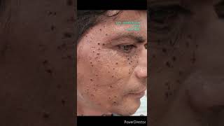 DPN  DERMATOSIS PAPULOSA NIGRA amp ITS REMOVAL VIA ELECTROCAUTERY [upl. by Natsyrt]