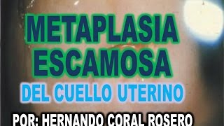 METAPLASIA ESCAMOSA DEL CUELLO UTERINO [upl. by Bartle]