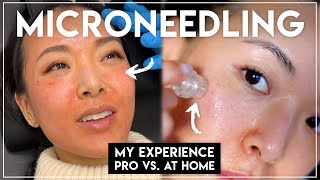 MY MICRONEEDLING EXPERIENCE Both Pro amp AtHome Treatments [upl. by Noeruat]