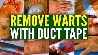 Can You Really Remove Warts with Duct Tape [upl. by Gmur]