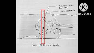 Bryants triangle  Hip joint special test [upl. by Stevana620]