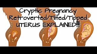 Cryptic PregnancyRetrovertedTiltedTipped Uterus Explained [upl. by Dnalon476]