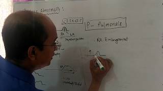 P wave abnormality p mitrale p pulmonale ECG [upl. by Lirba]