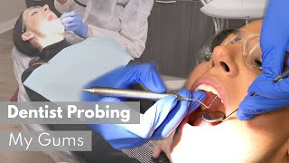 Dentist Probing My Gums Perio Charting Gingival Measurements [upl. by Loos]