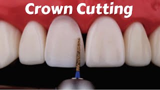 Crown Tooth Preparation Cutting for Anterior Incisor PFM Zirconia Ceramic Emax  Prostho Lecture [upl. by Uzial]