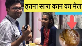 How to Remove Earwax best and easy way without pain [upl. by Evelinn]