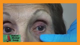 A Stye and a Chalazion  Auburn Medical Group [upl. by Trilbi613]