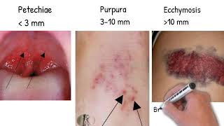 Bleeding diathesis Hemorrhagic Diathesis made simply [upl. by Katerine524]