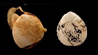 nuview Breast CT Implant with massive calcifications and a big rupture [upl. by Wilmar]