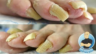 LONG TOENAILS FOR DAYS  TOENAIL CUTTING PART 1 [upl. by Pravit]