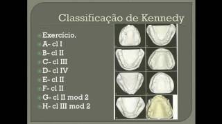 😉✅PRÓTESE PARCIAL REMOVÍVEL  CLASSIFICAÇÃO QUANTO AO SUPORTE E KENNEDY [upl. by Brook]