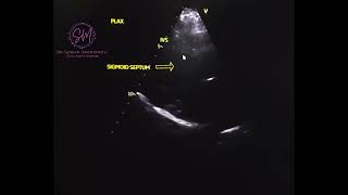 Echocardiography Sigmoid septum [upl. by Gare]