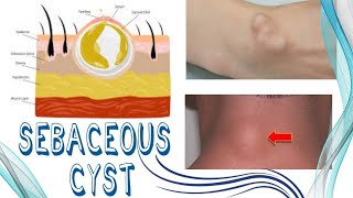 Sebaceous Cyst  Causes Diagnosis and Treatment  Surgical Procedure [upl. by Gennaro]