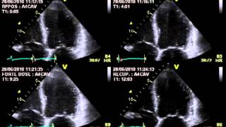 TRUE SEVERE AORTIC STENOSIS  STRESS ECHOCARDIOGRAPHY cardiac ultrasound [upl. by Mot]