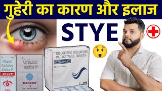 गुहेरी का कारण ओर इलाज  Stye  Causes Symptoms Treatment In Hindi [upl. by Algernon]