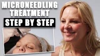 The Ultimate Microneedling Facial For Flawless Skin  Microneeedling Treatment Stepby Step [upl. by Ainevul200]