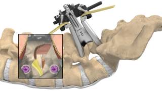 MAS® TLIF Patient Animation [upl. by Tomlin]