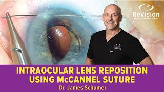 Intraocular Lens Reposition Using McCannel Suture WATCH SURGERY [upl. by Derk528]