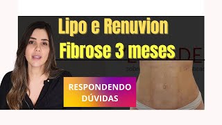 DÚVIDAS Lipo HD e Renuvion fibroses após 3 meses da Lipoaspiração [upl. by Harlie]