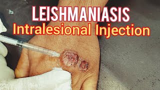 Leishmaniasis Treatment [upl. by Renaldo371]