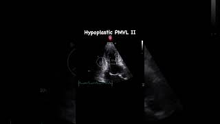 Hypoplastic posterior mitral valve leaflet  APLAX [upl. by Sieber224]