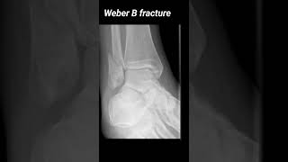 Oblique distal fibular fracture with lateral displacement of the distal fracture fragment xray [upl. by Ahker]