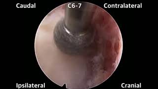 Full Endoscopic Stenosis Cervical Decompression [upl. by Ijnek]