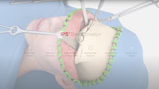 IPS® Transformation  Facial Feminization Surgery [upl. by Snashall277]