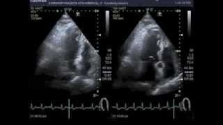 Bicycle stress echocardiography [upl. by Deland]