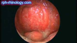 Acute Epiglottitis [upl. by Alamac]