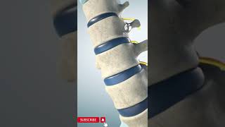 Spinal stenosis can be improved in one dayShorts [upl. by Wenona]