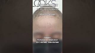 Alopecia Treatment by Dr Adil Hamayun [upl. by Jon]