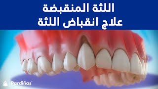 اللثة المنقبضة  علاج انقباض اللثة © [upl. by Alita]