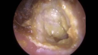 194 Eardrum about to EXPLODE after Blocked Ear Wax Removal using Endoscopic Ear Microsuction [upl. by Eibocaj518]